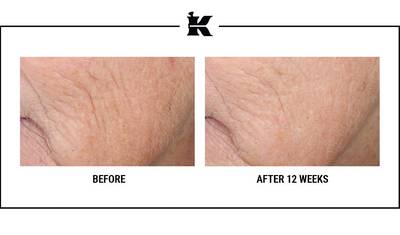 Before-and-after photos showing skin texture improvements after 12 weeks of treatment, highlighting reduced wrinkles and smoother skin.