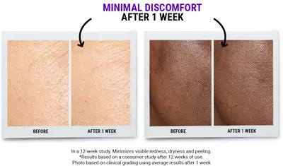 Image shows a side-by-side comparison of skin before and after one week of treatment. The left panel displays the skin's appearance before treatment, while the right panel shows the improved texture and tone after one week, highlighting minimal discomfort experienced during the process.
