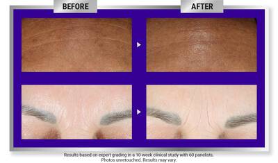 Before and after images showing skin improvement after a 10-week treatment, highlighting reduced wrinkles and smoother texture.