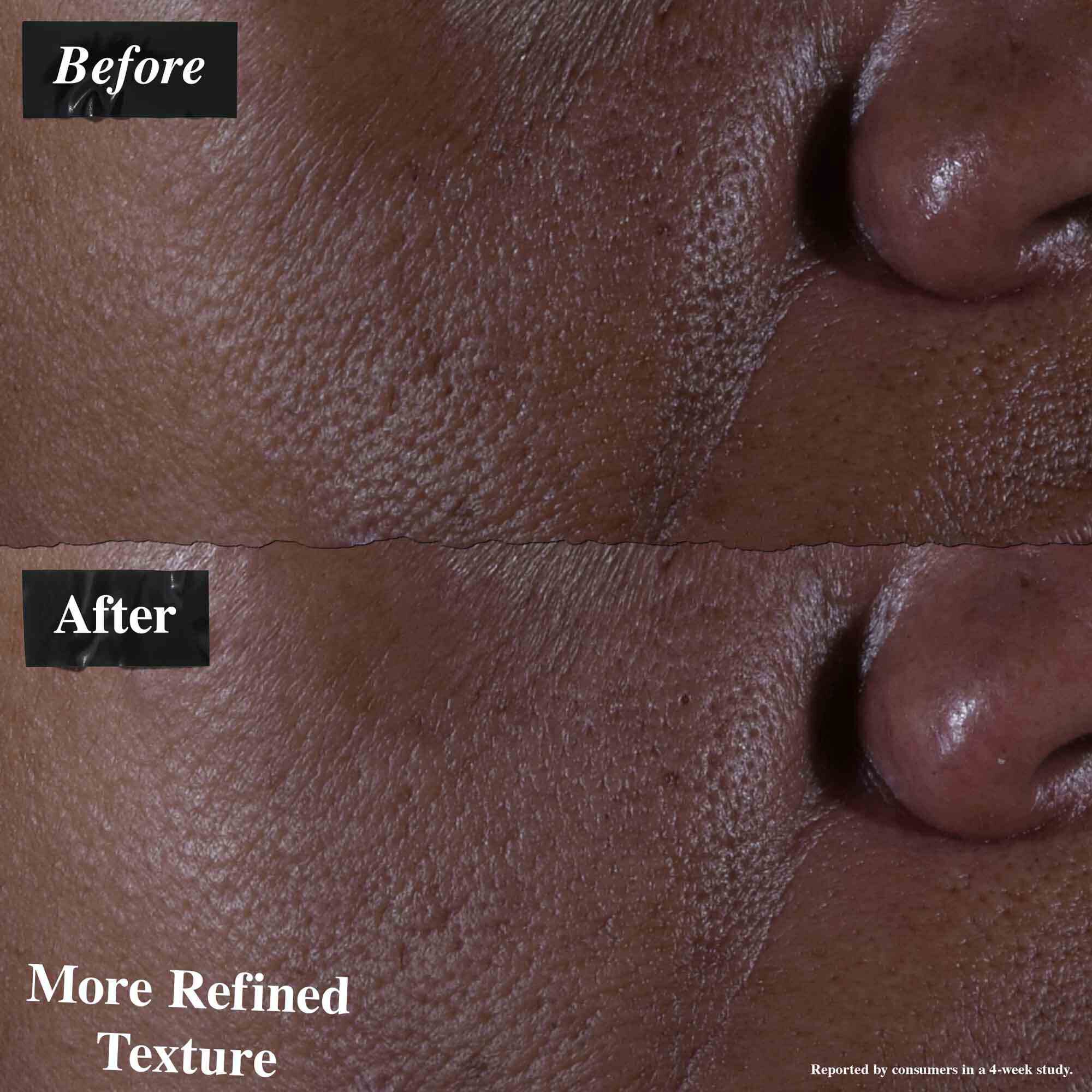 En før-og-efter sammenligning, der viser hud behandlet med Ultra Pure 9.8% Glycolic Acid Serum. "Før"-billedet viser ujaevn tekstur, mens "efter"-billedet viser mere forfinet tekstur.