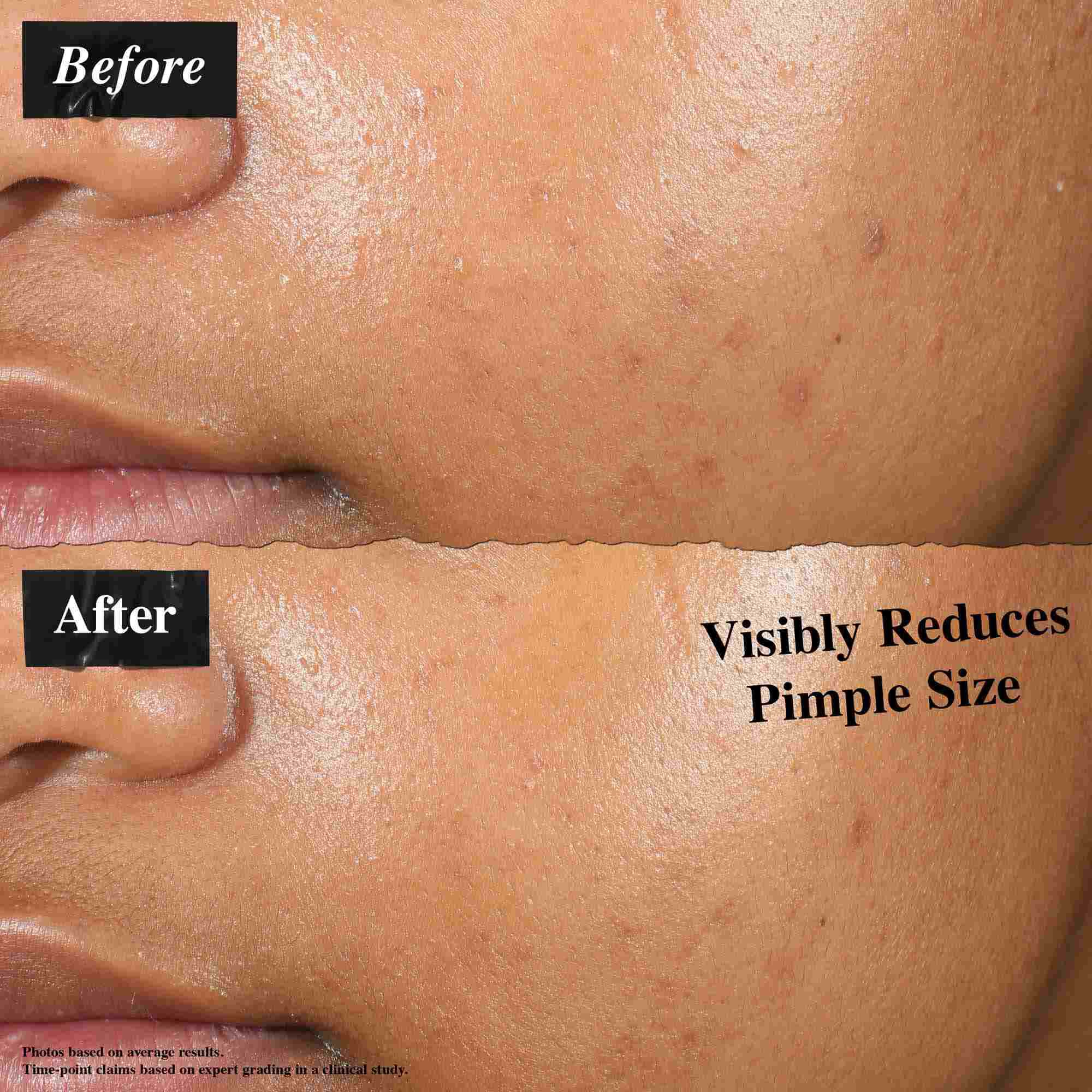 En før-og-efter sammenligning, der viser hud behandlet med Truly-Targeted Blemish-Clearing Solution. "Før"-billedet viser synlige bumser, mens "efter"-billedet viser reduceret bumsetørrelse.